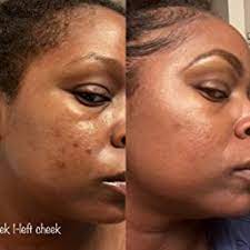 ژل ضدجوش دیفرین 30 گرم 3 ژل ضدجوش دیفرین 30 گرم - Image 3