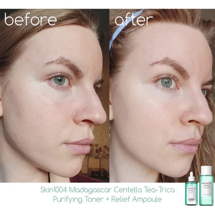 آمپول سنتلا ماداگاسکار تسکین دهنده چای تریکا Skin1004 4 آمپول سنتلا ماداگاسکار تسکین دهنده چای تریکا Skin1004 - Image 4